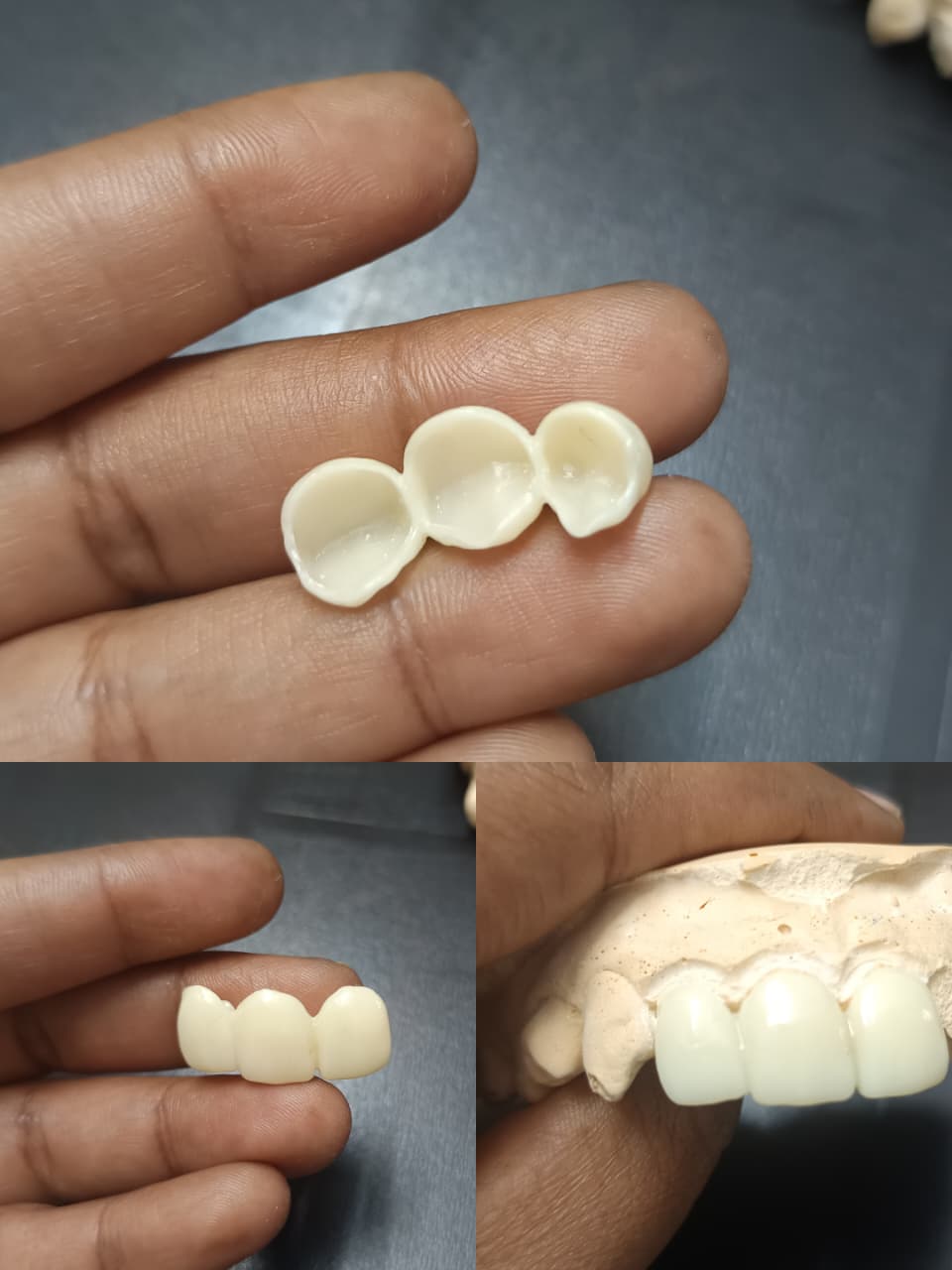 Dental implants at Nithya Dental Clinic Virugambakkam Chennai