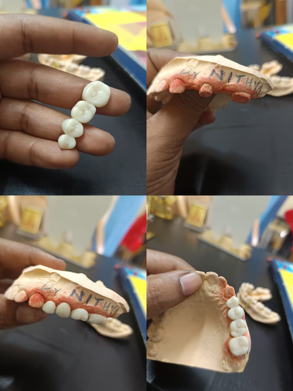Dental bridges treatment in Chennai