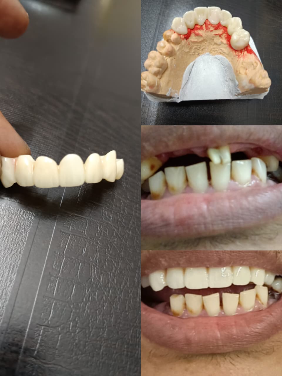 Dental bridges treatment in Chennai