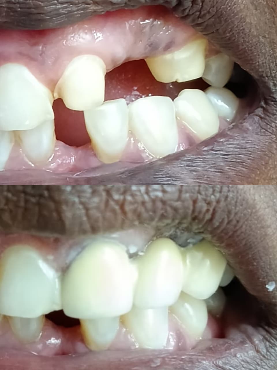 Teeth whitening at Nithya Dental Clinic Virugambakkam Chennai